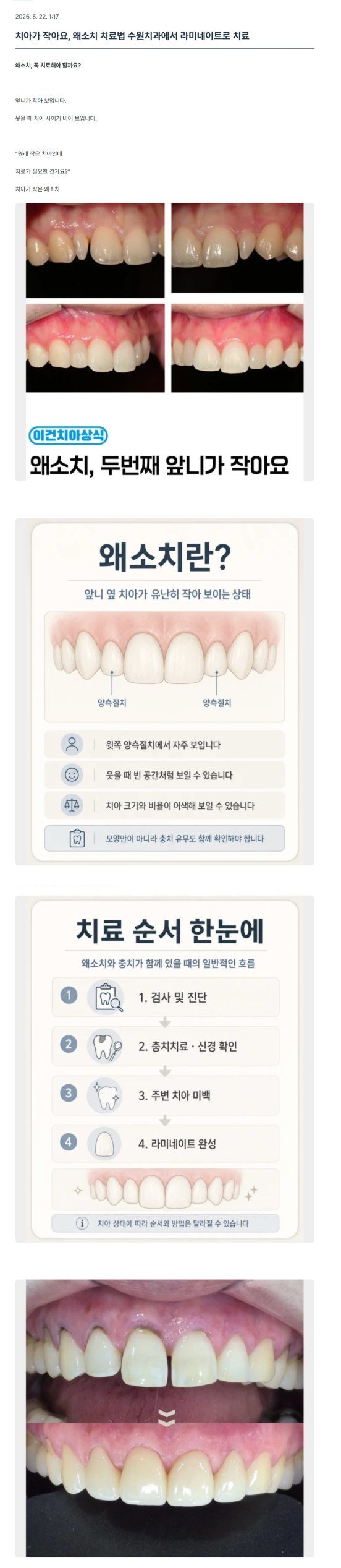 서울이건치과 원장칼럼 '치아가 작아요, 왜소치 치료법 수원치과에서 라미네이트로 치료' 화면. 왜소치 증례 사진, 왜소치란 인포그래픽, 치료 순서 안내, 라미네이트 전후 사진